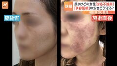 「美容医療」の安全どう守る　シミ治療でやけども　トラブルの背景に経験・知識が浅い医師による施術　厚労省が対策案示す| TBS CROSS DIG with Bloomberg