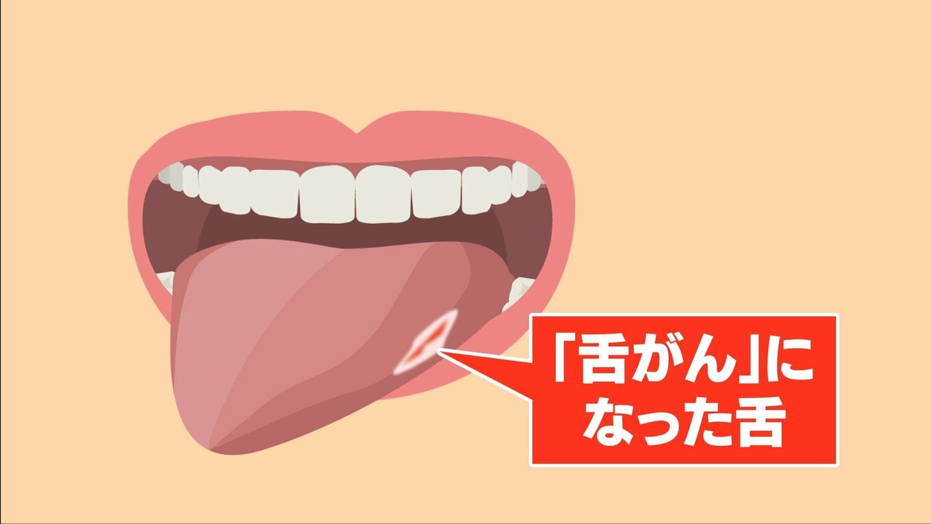 20年で倍増…増える若年層の「舌がん」 現代人特有の “狭い歯並び” が引き金に? 口内炎との決定的な違いとは | TBS NEWS DIG ...