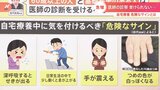 「深呼吸すると咳」「爪の色が白っぽく」新型コロナ自宅療養中に見逃してはいけない4つの「危険なサイン」|TBS NEWS DIG