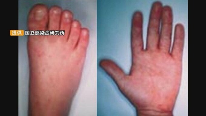 広島県内で２年ぶり「手足口病警報」発令　福山市で基準超える　乳幼児の高熱に注意　|TBS NEWS DIG