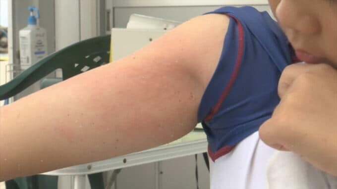 少年の顔は赤く腫れあがり…「アンドンクラゲ」大量発生　被害に遭う海水浴客が急増　なぜ？　|　BSSニュース | BSS山陰放送
