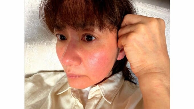 【がん闘病】古村比呂さん　「薬アレルギー」の苦境　「薬疹が出ると身体全体が浮腫みます」「体重が3キロもアップ」「下肢のリンパ浮腫がパンパンに腫れちゃって」|TBS NEWS DIG