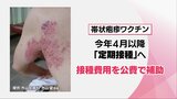 4月以降ワクチン定期接種開始へ 80歳までに3人に1人が発症「帯状疱疹」 眠れぬほどの激痛も・・・ その症状とワクチンの効果は? | MRTニュース | MRT宮崎放送