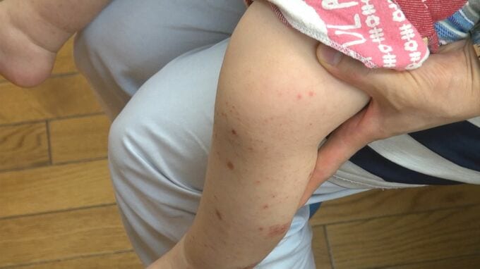 乳幼児に多い「手足口病」 コロナ禍明けで感染が拡大 医師は「一般的な感染対策の徹底を」　|　石川県のニュース｜MRO北陸放送