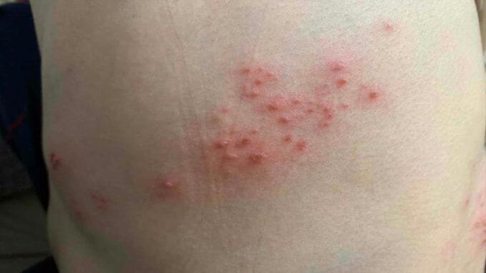 コロナ禍で「帯状疱疹」患者が増加か　ワクチン接種後に「帯状疱疹」症状出るケースも…　|　BSSニュース | BSS山陰放送