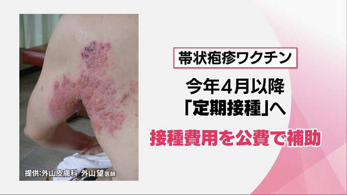 ４月以降ワクチン定期接種開始へ　 80歳までに3人に1人が発症「帯状疱疹」 眠れぬほどの激痛も･･･　その症状とワクチンの効果は?　|　MRTニュース ｜ ＭＲＴ宮崎放送