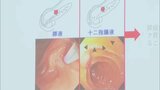 「膵臓がん」早期発見へ 世界初の新たなスクリーニング法を開発 胃の内視鏡検査の際に十二指腸液を採取し診断 九州大学病院 | 福岡のニュース|RKB NEWS|RKB毎日放送
