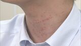 全身に赤いブツブツ…年度がわりは「じんましん」に注意　環境変化、ストレスがきっかけで発症するケースも　|　BSSニュース | BSS山陰放送