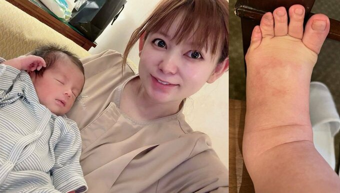 【 中川翔子 】 「双子ワンオペ無理」「大変さもあるけどそれ以上に愛おしい」 現況明かす 「むくみとのたたかい 着圧ソックス履く前と履いた後の違いがすごすぎる」|TBS NEWS DIG