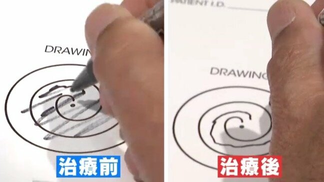 高度な医療サービスを受けるため日本へ 外国人の需要が高まる「医療ツーリズム」 超音波を脳に照射する最新治療を受ける中国人男性に密着 【チャント!大石が聞く】|TBS NEWS DIG