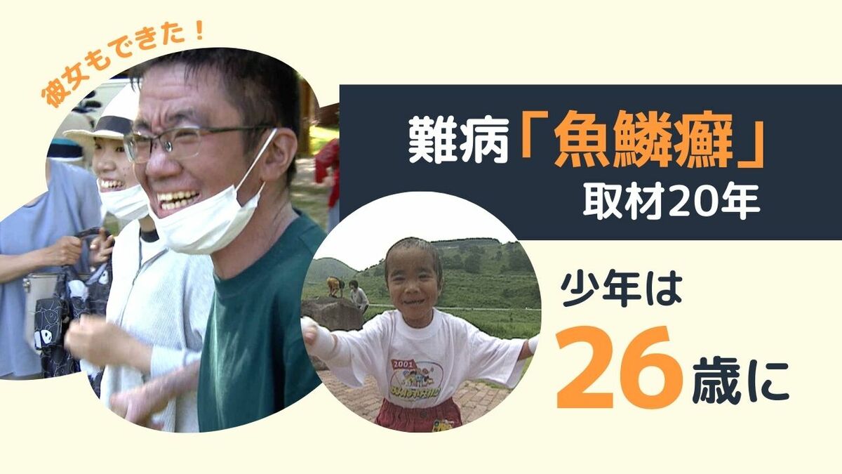 皮膚がウロコのように 難病 魚鱗癬 取材２０年 ２６歳になった青年に彼女が Tbs News Dig