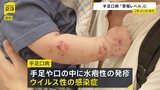 手足口病 2週連続で「警報レベル」1医療機関あたり9.12人　厚労省は手洗いの徹底など呼びかけ|TBS NEWS DIG