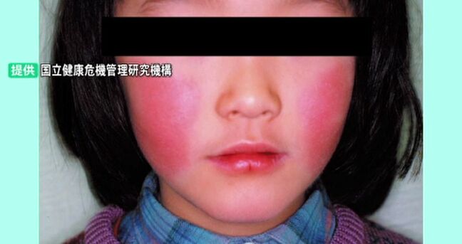 「リンゴ病」患者が急増 石川県が6年ぶりに警報を発令 “妊婦感染で流産の恐れも”注意呼びかけ|TBS NEWS DIG