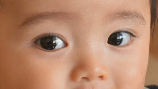 子どもが急に“パッチリ二重”に…「これはやばい」なぜ？　保護者が戦々恐々とするワケ　医師が解説…まぶたの状態でわかる“体調変化”とは？|TBS NEWS DIG