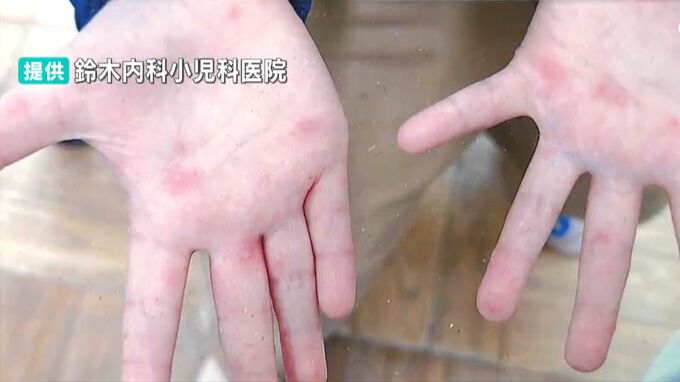 『手足口病』夏季は感染拡大の傾向　家庭内での感染にも注意　新潟県|TBS NEWS DIG