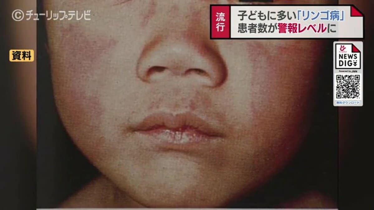妊娠 後期 りんご 病