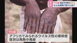 マスク生活で免役力低下か? “サル痘”感染 世界で広がる【ひるおび】|TBS NEWS DIG