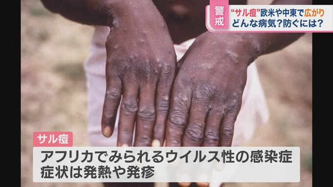 マスク生活で免役力低下か？　“サル痘”感染 世界で広がる【ひるおび】|TBS NEWS DIG
