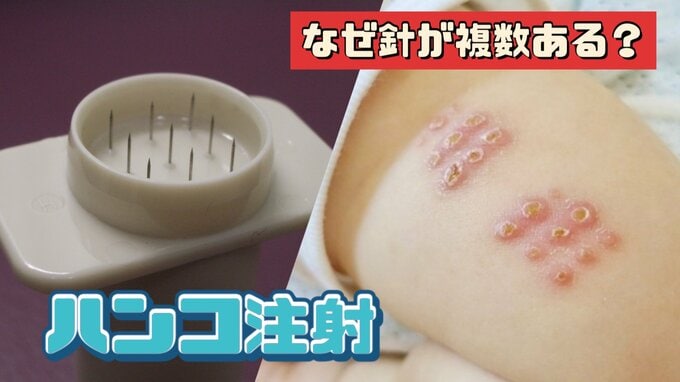 腕に残る18の点  “ ハンコ注射 ” はなぜあの形？多くの人は「体に結核菌が眠っている」発病を防ぐには…　|　富山のニュース｜天気・防災｜チューリップテレビ