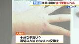 【手足口病】大阪府でも「警報レベル」超え 十分な手洗いや適切な方法でのおむつ交換を呼びかけ 近畿では京都府・兵庫県・奈良県でも「警報レベル」超え|TBS NEWS DIG