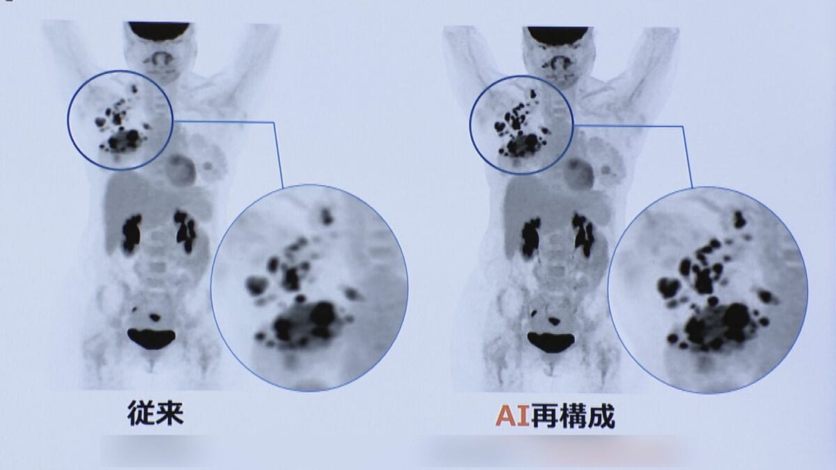 AIで｢がん｣の見落とし防ぐ 細胞の活動状況や臓器の形を撮影… 従来より