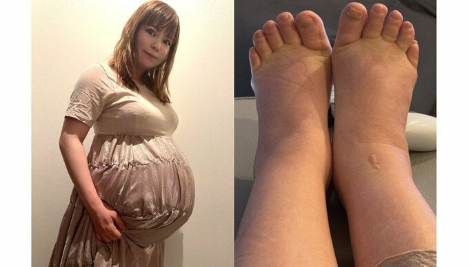 【 中川翔子 】 「むくみも人間の限界にきてる」 双子妊娠中 現況明かす 「塩分だけじゃなく双子の圧迫もある、、あと少しを楽しむ!ギリギリまでがんばろう」|TBS NEWS DIG
