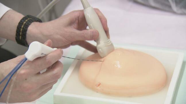 “切らずに治す” メスを使わない乳がん治療「ラジオ波焼灼療法」早期の乳がんに有効 “約10分で腫瘍を焼く” 傷跡小さく体に優しい…保険適用の選択肢|TBS NEWS DIG