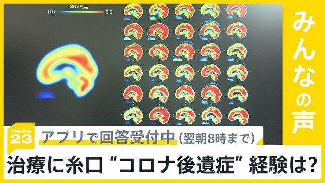 新型コロナの後遺症“ブレインフォグ”治療に糸口　あなた、もしくは周りで後遺症経験した人は？【news23】|TBS NEWS DIG