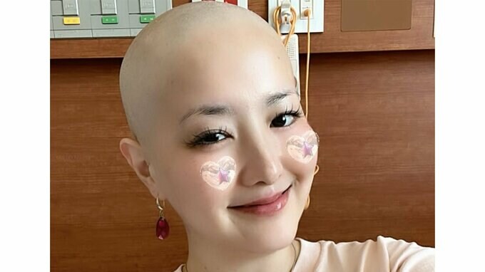 【がん闘病】希良梨さん　第3クール目の「抗がん剤」投与　「抗がん剤を投与していると血管が細くなったり、固まったりするので針が差しづらくなる」「私の腕はあざだらけですが　それは私の勲章です」|TBS NEWS DIG