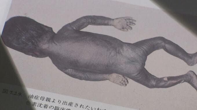 黒い赤ちゃん…原因のPCB製造企業は沈黙　次世代まで続く‟カネミ油症”　|　長崎のニュース | 天気 | NBC長崎放送