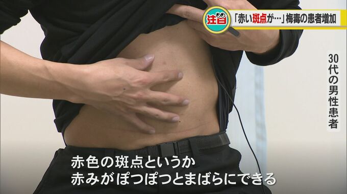 赤い斑点が…“梅毒”患者に医師「個人だけの問題ではない」過去最多の去年上回るペースで増加　|　石川県のニュース｜MRO北陸放送