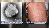 はしか急増中!「すれ違ったらうつる」驚異の感染力 「海外からの持ち込み」「低い接種率」要因は複数 熊本県内 | 熊本のニュース|RKK NEWS|RKK熊本放送