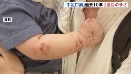 速報】「手足口病」過去10年で最多に迫る 16週連続増 1医療機関