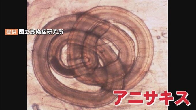 寄生虫「アニサキス」食中毒　スーパーで買ったイワシの刺身を食べたら…胃痛・嘔吐　|　BSSニュース | BSS山陰放送