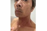 ステージ4【下咽頭がん】 見栄晴さん 「肌が赤み帯びて痛がゆく」 放射線治療の結果 皮膚に影響が|TBS NEWS DIG