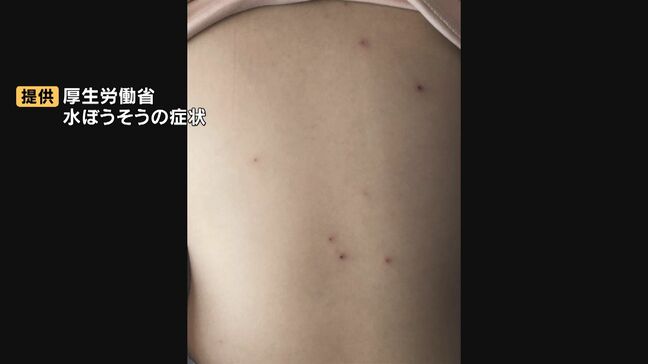 水ぼうそう流行のおそれ　 大分県で患者急増、6年ぶり注意報発令|TBS NEWS DIG