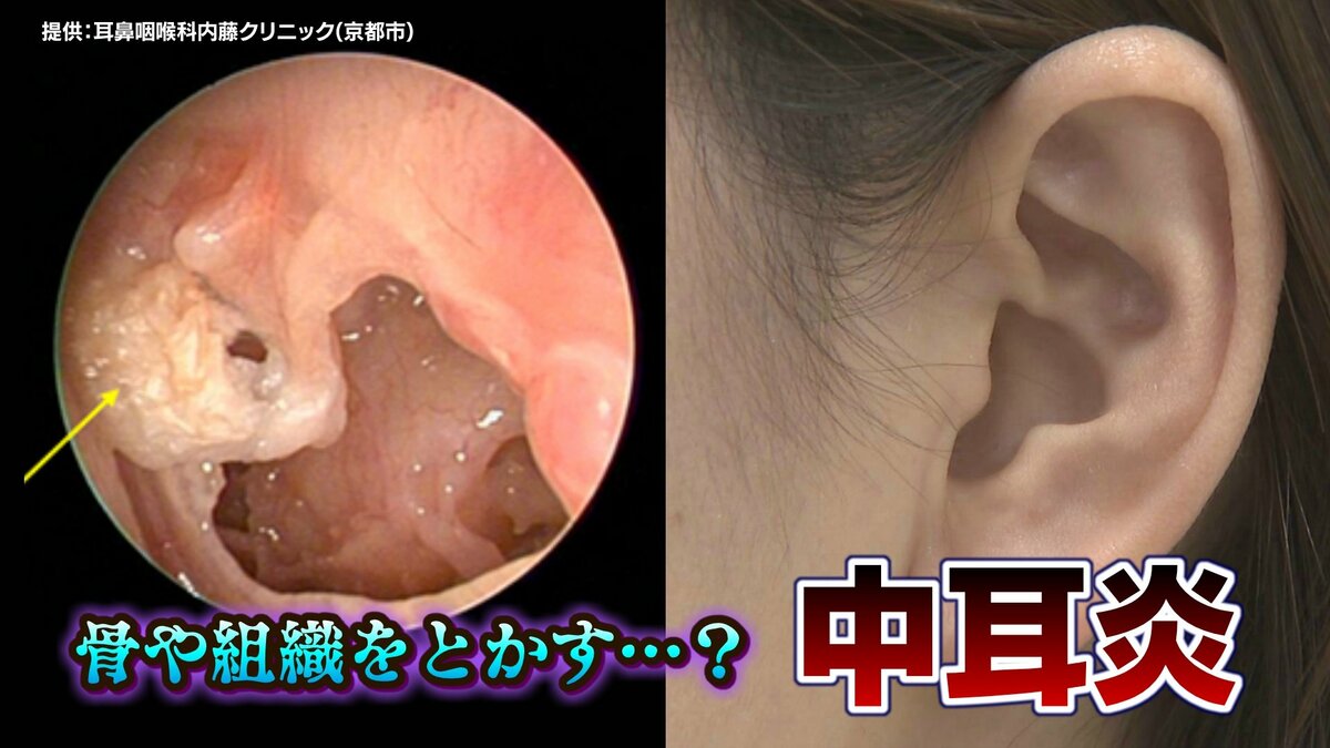 徐々に周りの骨を溶かして…」放っておくと危険な “中耳炎” 子どもから