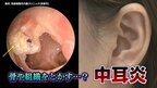 「プールで耳に水が入って中耳炎」間違い？！大人も要注意…放置すると危険な“中耳炎”　骨や組織を溶かすことも|TBS NEWS DIG