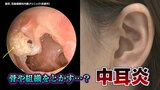「プールで耳に水が入って中耳炎」間違い?!大人も要注意…放置すると危険な“中耳炎” 骨や組織を溶かすことも | 富山のニュース|天気・防災|チューリップテレビ