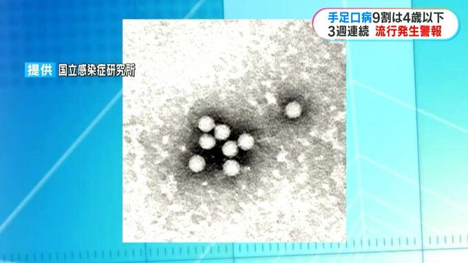 「手足口病」感染者9割は4歳以下の幼児　3週連続で流行発生警報　新型コロナも4週連続増加　|　鹿児島のニュース｜MBC NEWS｜南日本放送