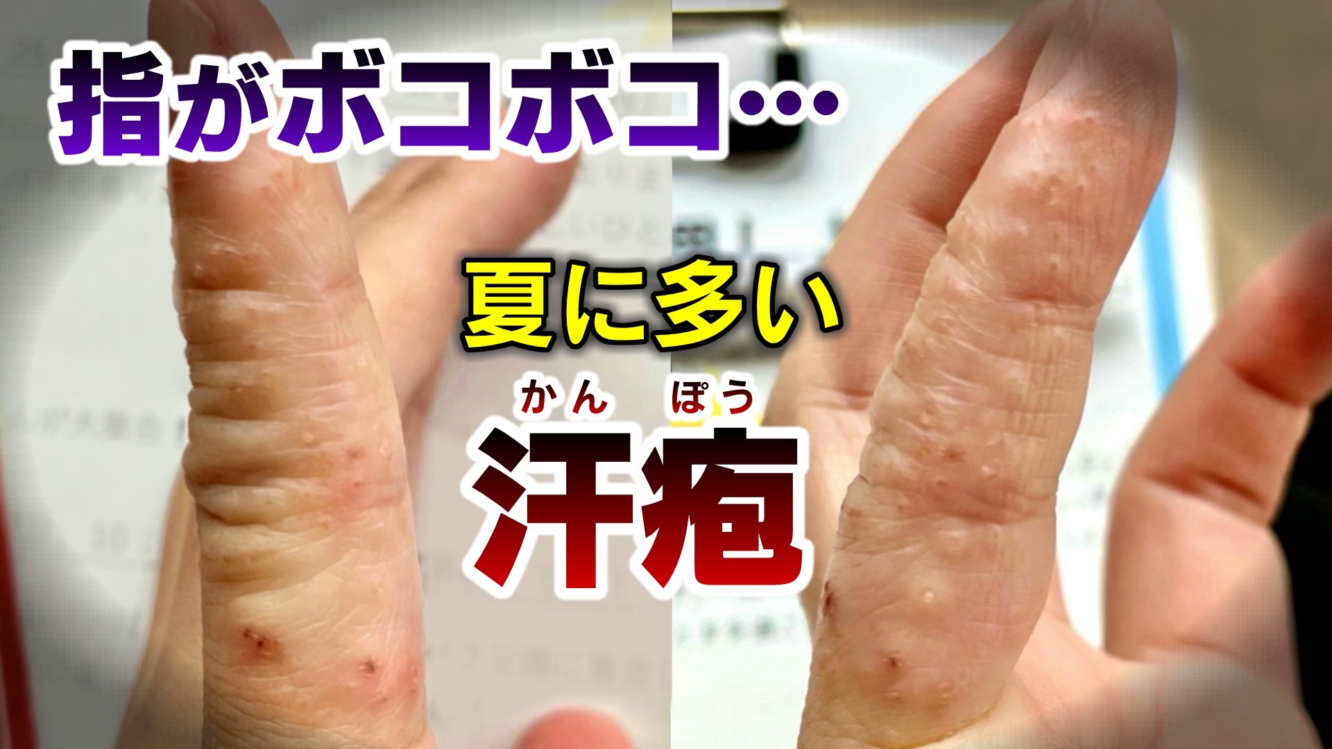 指 水ぶくれ