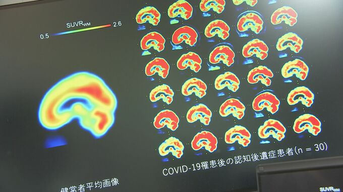 「ブレインフォグ」解消の糸口掴む コロナ後遺症患者の脳を分析「アンパ受容体」の密度が健常者より高いと判明 横浜市立大学病院の研究結果「治療法開発につながる成果」|TBS NEWS DIG