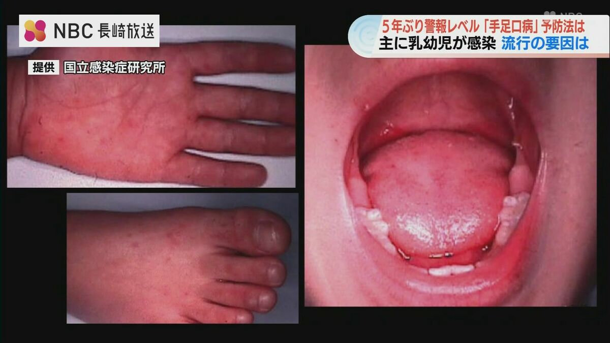 2歳未満が患者の75％「手足口病」が急増中 子どもと家族を守るための