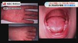 2歳未満が患者の75%「手足口病」が急増中 子どもと家族を守るための対策 | 長崎のニュース | 天気 | NBC長崎放送