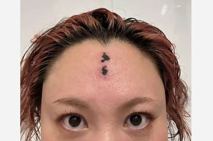 【 バービー 】 「ただの悪化した虫刺されです」　ＳＮＳにつづる　「Instagramがこの額を梵字のタトゥーと認識したのか…」　ファンも心配　「跡残らず治ります様に､､」|TBS NEWS DIG