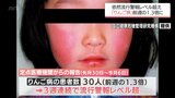 宮崎県内の「りんご病」の患者数 前週の1.3倍に 3週連続「流行警報レベル」超える | MRTニュース | MRT宮崎放送