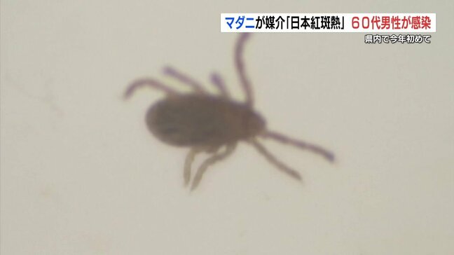 マダニが媒介「日本紅斑熱」今年初めて感染確認　熊本|TBS NEWS DIG