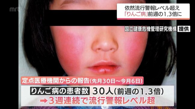 宮崎県内の「りんご病」の患者数 前週の1.3倍に 3週連続「流行警報レベル」超える|TBS NEWS DIG