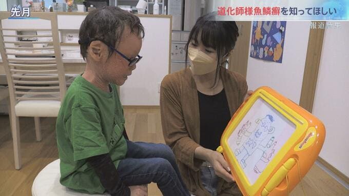“産まれてすぐピエロと呼ばれた息子”　難病・道化師様魚鱗癬と闘う家族の日常【報道特集】|TBS NEWS DIG