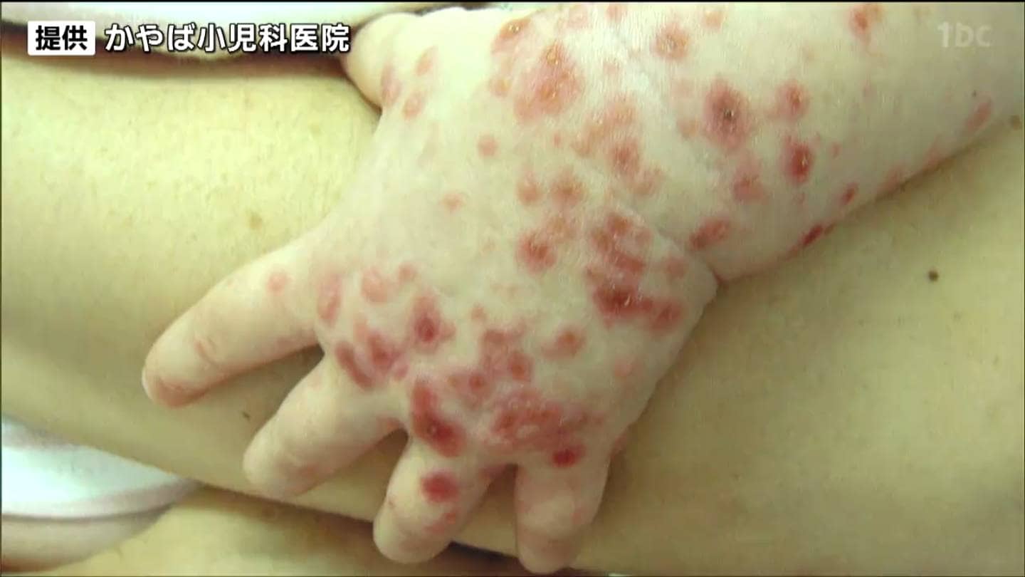 手到病自除 手足口病」1医療機関あたり20人超も警報レベル大幅に上回る 宮城
